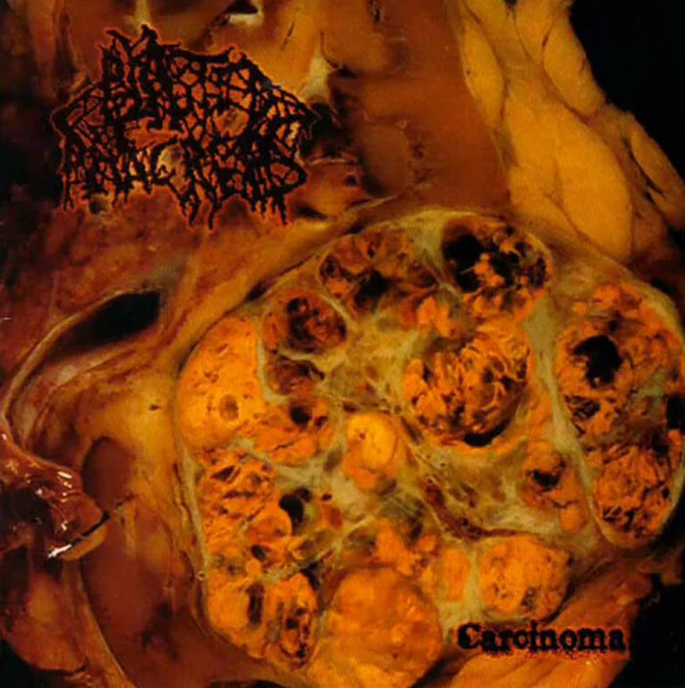 Blasted Pancreas - Carcinoma LP